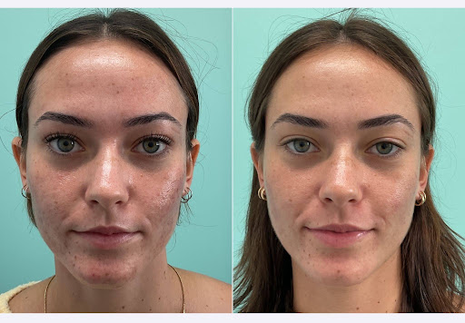 Acne management team approach at Skin Alert Paradise Point